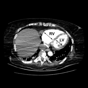 CT scan showing right ventricular strain in a patient with pulmonary embolism, highlighting right ventricular enlargement and flattening of the interventricular septum