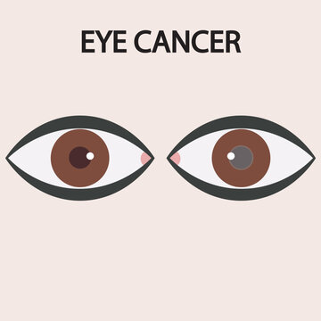 Eye cancer vector illustration showing symptoms like vision loss, eye pain, redness, and visible lumps, with related diseases such as conjunctivitis, glaucoma, and retinoblastoma for comparison icon