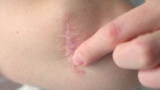 captures a forearm scar from melanoma removal being examined closely, highlighting the healing skin texture and the gentle touch, significance of monitoring recovery and skin health