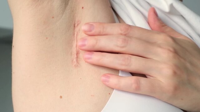 Scar under armpit after lymph node removal, showing gradual progression of healing process, with hand gently touching scar, emphasizing skin texture and recovery journey in a clinical setting