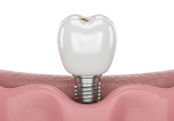 3D Render of a Dental Implant with Crown and Post in Gum Tissue - Restoring Oral Health and Smile