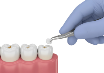 Dental Restoration Process: Dentist's Hand Applying a Filling to a Molar Tooth Model