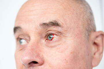 Bloodshot male eye in close-up shot, revealing raw detail burst vessel and underlying stress,...