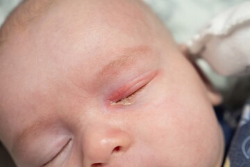Baby eyes with eye mucus in selective focus. Disease tear ducts tons of newborns close up. Nasolacrimal duct obstruction in baby it is a blockage of the lacrimal drainage system. 