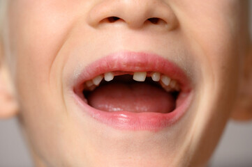 Child opens mouth, showing fallen baby tooth and hole from it, close-up. Baby teeth are replaced by permanent ones. Children's dentistry concert.