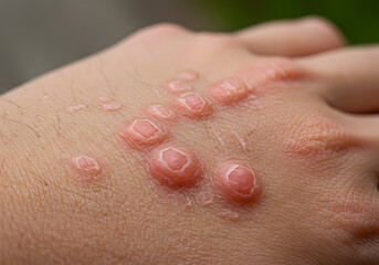 Fototapeta premium Red skin irritation on hand