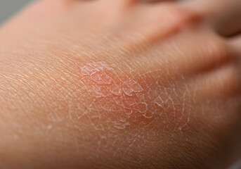 Fototapeta premium Skin condition closeup
