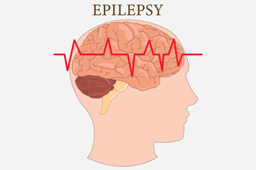 Medical diagram of epilepsy showing brain activity with electrocardiogram red waveform.