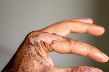 Fototapeta premium Close up of human hand with peeling skin after hot water scald burn, showing healing stage, trauma recovery, dermatology issue, and medical treatment process.