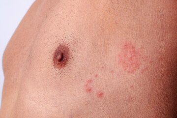 close-up of shingles on the chest of a man