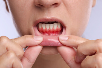 Fototapeta premium Woman showing inflamed gum on light background, closeup