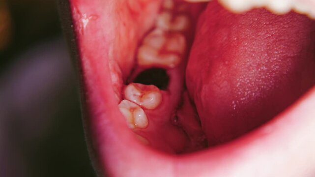 Close-up of an open mouth with a blood clot at the site of the extracted tooth. Dental cavity with a blood layer after surgery
