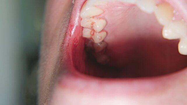 A close-up view of a person's mouth showcasing teeth with visible decay and bleeding gums, highlighting dental health issues requiring attention