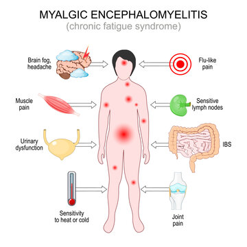 Symptoms of Myalgic Encephalomyelitis. Chronic Fatigue Syndrome
