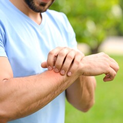 Man scratching wrist outdoors, itching