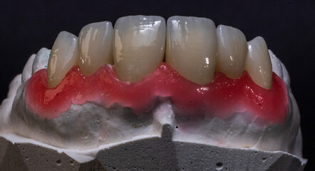 Zirconium crowns on a upper jaw model in aesthetic dentistry. © Алена Пахомова