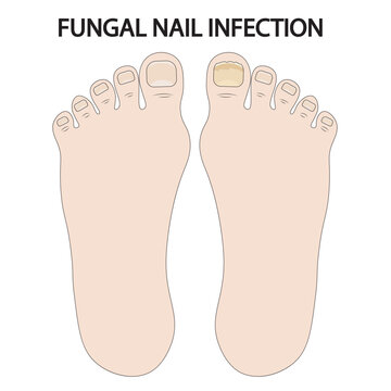 Vector illustration of fungal nail infection showing thickened, discolored, brittle nails, crumbling edges, odor, and related conditions like psoriasis, trauma, and bacterial nail disorders icon