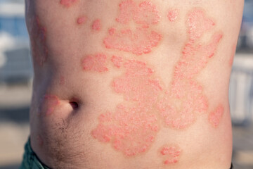 Fototapeta premium Individual With Psoriasis Exhibiting Skin Lesions on the Torso in a Natural Outdoor Setting During Daylight Hours