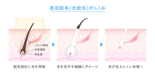 美容脱毛・光脱毛のイラスト