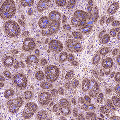 Photomicrograph of immunohistochemistry for HER2,  showing positive cell membrane staining in this infiltrating ductal carcinoma.   Candidate for Herceptin.
