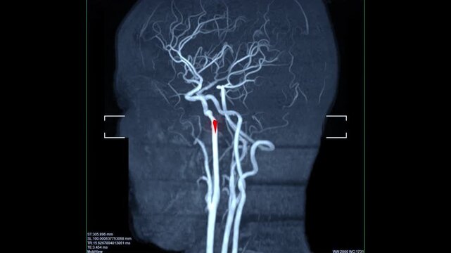 brain stroke x-ray and anatomy angiography mri show is aneurysm and cerebrovascular disease that has intracranial hemorrhage stroke.	
