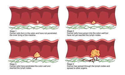 Illustration of colorectal cancer stages. Concept of colon cancer progression. Spread of tumor to lymph nodes. Medical vector illustration for clinics, education, and science.