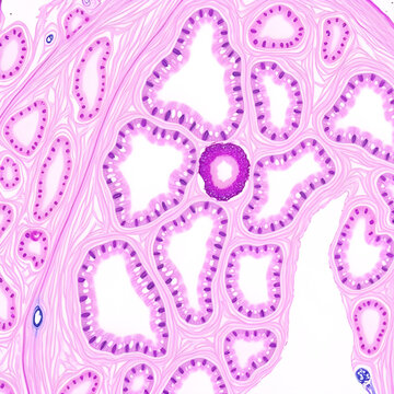 Microscopic image of lobular carcinoma arising in the lobules of the breast, showing the characteristic small