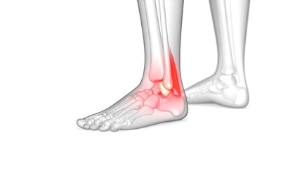 3D anatomical illustration of a painful ankle joint (1)