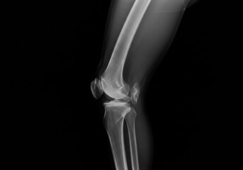 Detailed lateral view X-ray of an adult human knee joint, showcasing bone structure and medical anatomy for diagnostic purposes