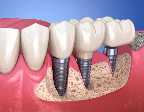 Cleavage of the alveolar ridge implantation. Dental surgery, 3D illustration.teeth, crest, dental, dentistry, increase, losing, loss, recession, recovery, render, surgery,Generative AI