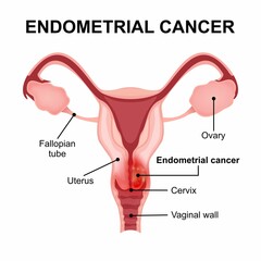 Endometrial cancer medical flashcard illustration