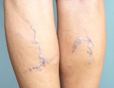 Varicose veins on lower legs