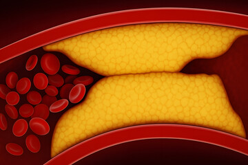 Medical illustration artery blockage cholesterol buildup affecting blood flow cardiovascular health disease concept