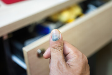 Obraz premium Human thumb finger is hurt by drawer pinched, cause blood blister inthe nail. Unsafe or hazard at workplace, close-up with selective focus.