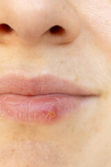 Macro Closeup of Herpes on Human Lip.