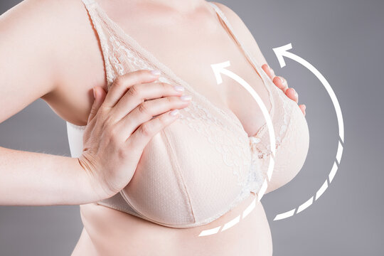 Breast augmentation, woman with large saggy breasts after aesthetic lifting procedure, reduction mammoplasty, plastic surgery, healthcare and medicine concept
