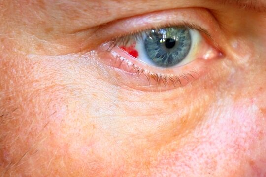 Close-up of human eye with subconjunctival blood spot
