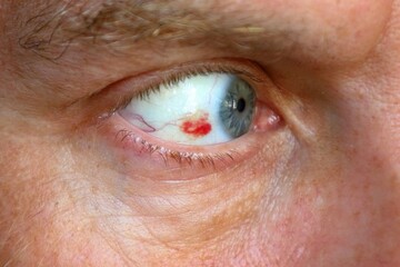 Fototapeta premium Close-up of human eye with subconjunctival blood spot