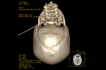 Medical themes: CT Scan of Intraparenchymal hematoma in the left basal ganglia with extension to the temporal lobe and mass effect.