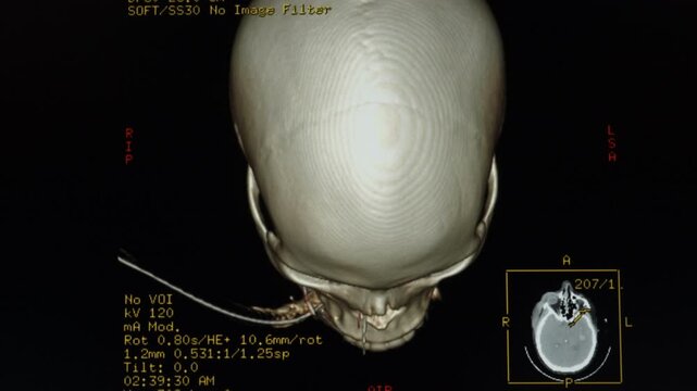 Medical themes: CT Scan of Intraparenchymal hematoma in the left basal ganglia with extension to the temporal lobe and mass effect.