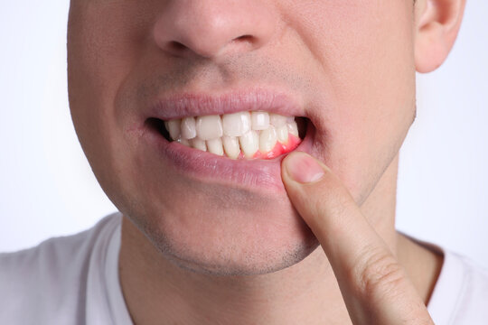 Man showing inflamed gum on white background, closeup