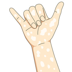 Obraz premium Hang loose pose vitiligo people. Unique skin pigmentation highlighting natural beauty. World vitiligo day. Skin depigmentation, skin disorder, self acceptance, emotional support.