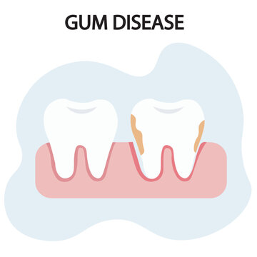 Vector illustration of gum disease showing bleeding gums, redness, swelling, bad breath, and tooth loosening, with related conditions like gingivitis, periodontitis, and oral infections.pain