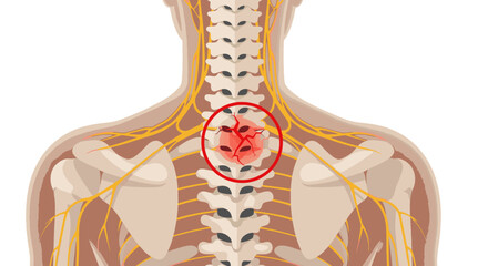Illustration of Human Spine and Nervous System with Highlighted Pain Area in Upper Back Representing Injury or