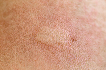 Fototapeta premium Swelling on the skin from insect bites
