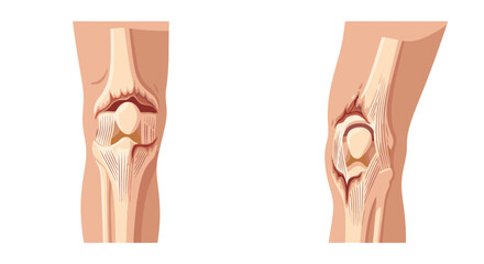 Detailed Medical Illustration of Healthy Human Knee Joint Compared to Osteoarthritis Condition with Cartilage