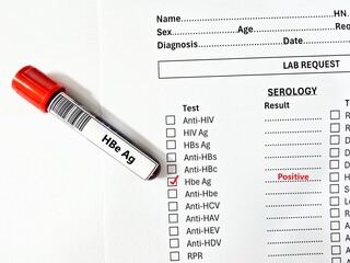 Obraz premium Blood sample tube positive result for HBe Ag.