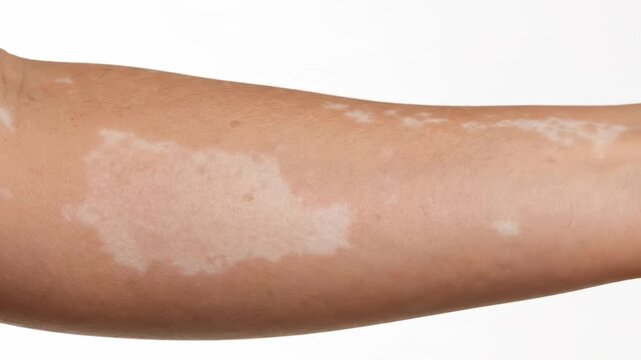Vitiligo on Arm - Close-up view of a person's arm displaying patches of vitiligo, a skin condition causing loss of pigment. The video shows depigmented areas against normal skin tone on a forearm.