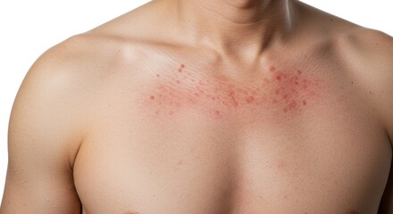 Naklejka premium Man with Shingles Skin Rash Caused by Herpes Zoster Virus , Medical and Healthcare Dermatology Concept