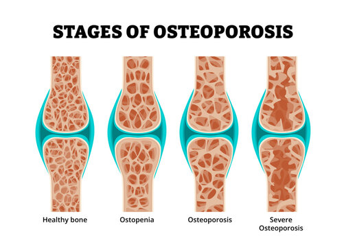 Stages of Osteoporosis bone stages development diagram process for educational medical poster design healthcare scheme, healthy bone, osteopenia, osteoporosis, severe. Skeletal Senior osteopathy